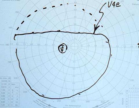 57 year old woman who complains “The lids are somewhat down”