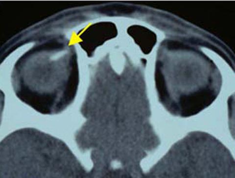 7 year old girl with a left face turn and binocular diplopia