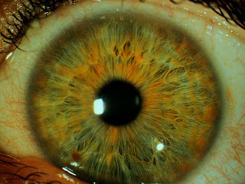 29 year old man with visual symptoms and headaches