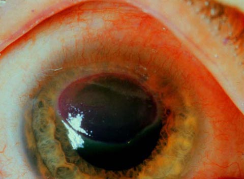 Epithelial defect on the right cornea was well dilineated with rose bengal stain.