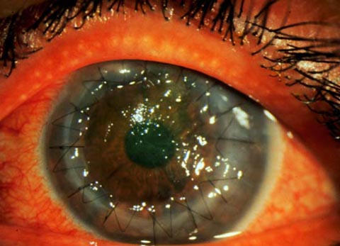 39 year old Hispanic woman with a ten year history of gradual blurring of vision in both eyes