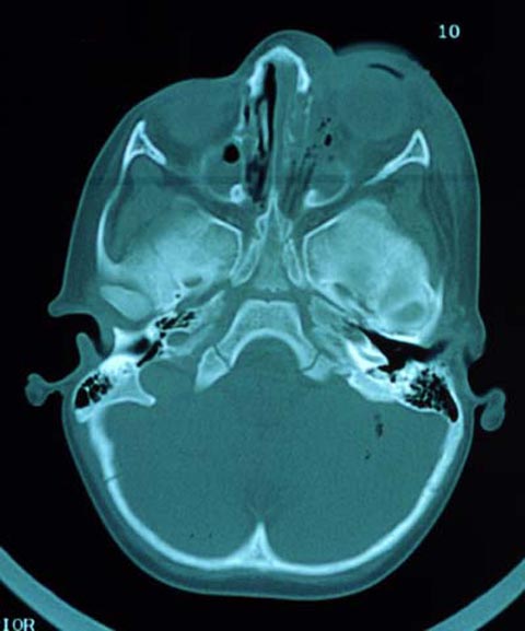 3 year old boy with swelling under the left eye