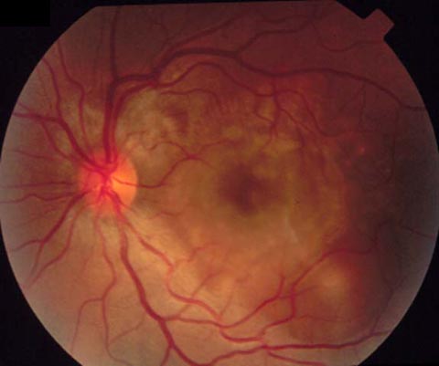 27 year old woman with blurred central vision OS and headache