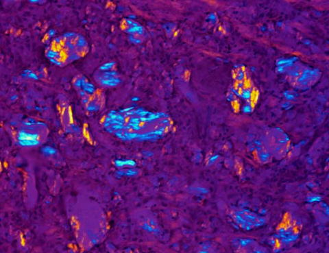 The birefringent material was noted to dissolve in processing and paraffin embedding suggesting a lipid composition.