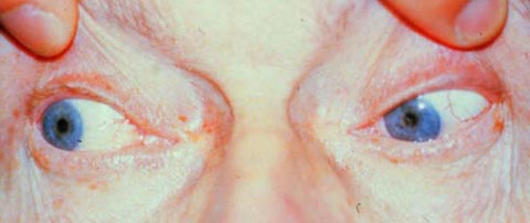 A 54-year-old man with diplopia.