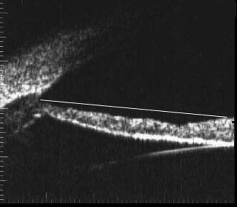 Ultrasound biomicroscopy showing posterior bowing of the iris.