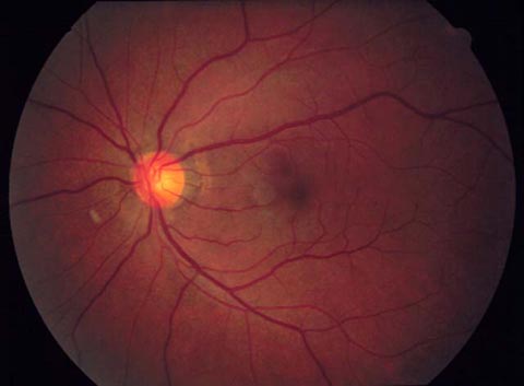 38-year-old man with CMV retinitis