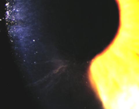 Eye with Amidodarone vortex kertopathy note the corneal deposits