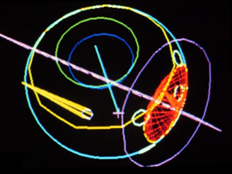 Computer-generated three-dimensional model of a the eye with a tumor.