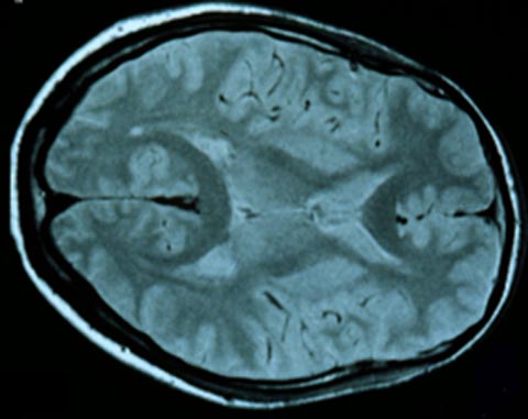 MRI demonstrating left occipital lobe hyperintensity