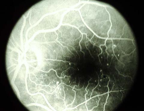 Early frame of a fluorescein angiogram negative (fluorescein dye is white)