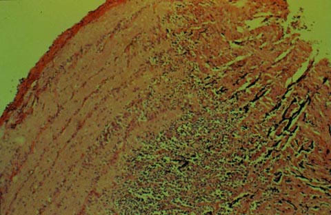 Pathologic specimen of the patient's optic nerve showing the surgical margin of optic nerve positive for retinoblastoma.