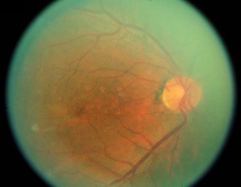 Mild mottling of the retinal pigment epithelium in the macula.