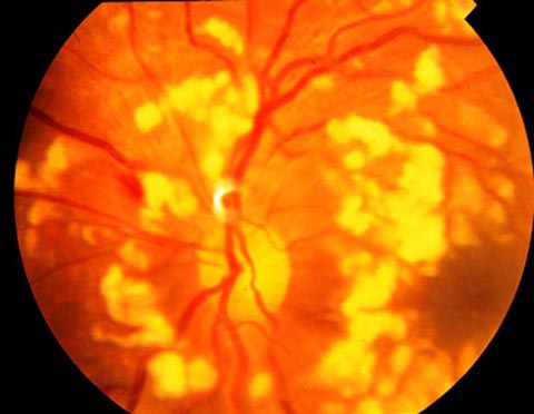 Multiple large superficial cotton wool spots surrounding a normal looking optic nerve.
