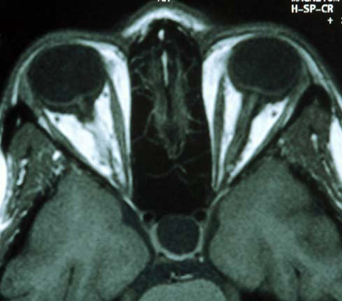 Axial T1-weighted MRI image showing prominence of the optic disks no masses present in the orbit.