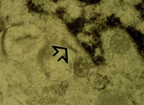 Electron microscopy demonstrated the presence of Birbeck granules (arrow) within a few of the histiocytes.