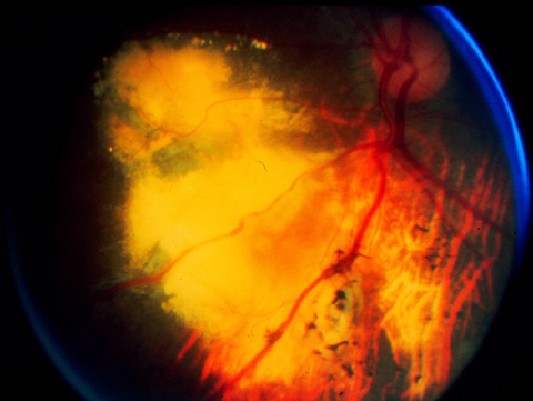 Inferonasal view of the fundus OS displaying the extent of the previews findings.