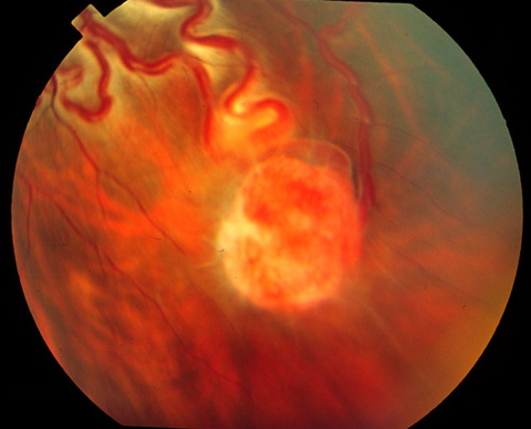 Vascular tumor in the inferior periphery with large feeder vessels.