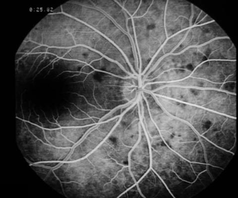 Early hypofluorescence of the lesions.