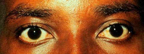 Left pupil slightly larger than the right pupil.