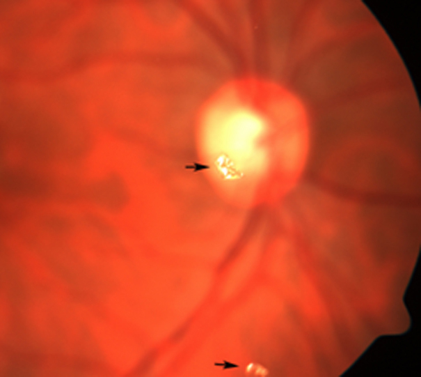 Translucent particles (black arrows) floating in the vitreous (A); the media is clear with no evidence of intraocular inflammation