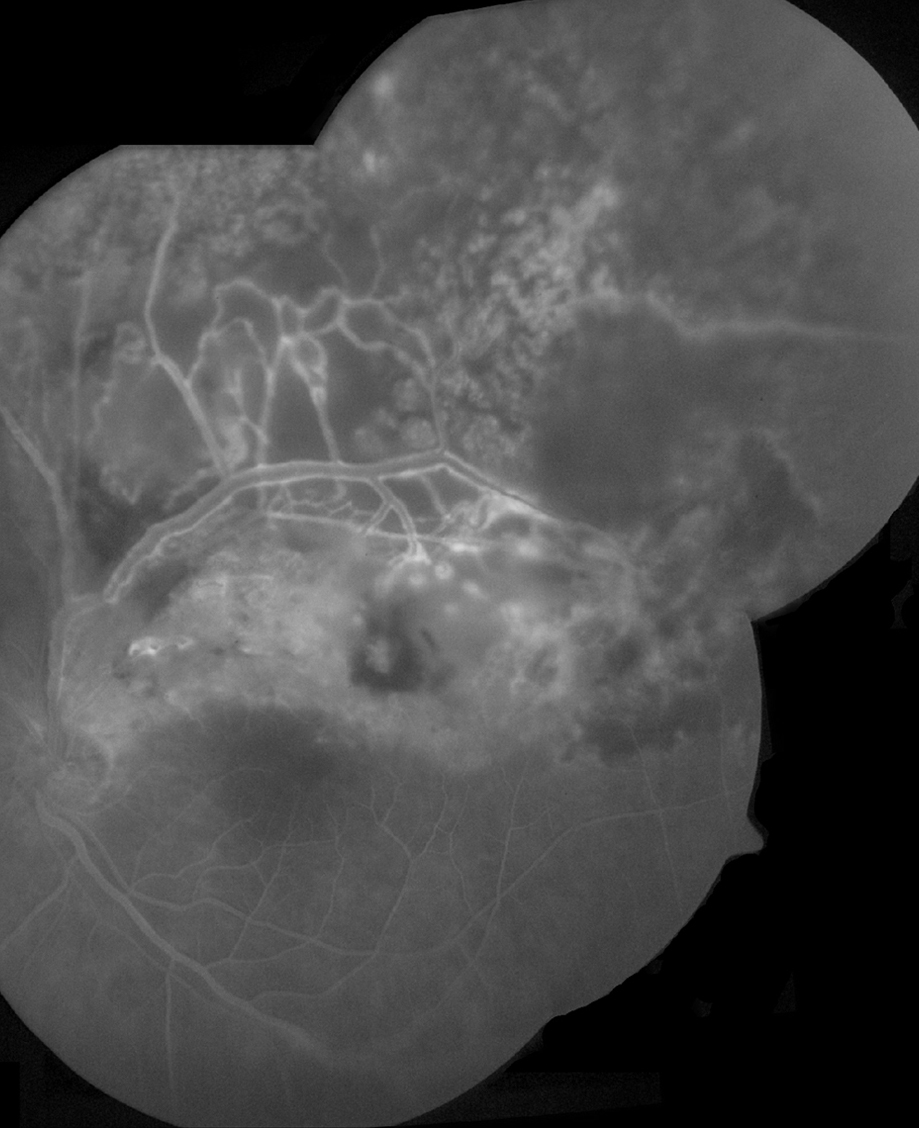 Fluorescein angiogram showing retinal hyperfluorescent lesion and vascular dilation with vessel staining