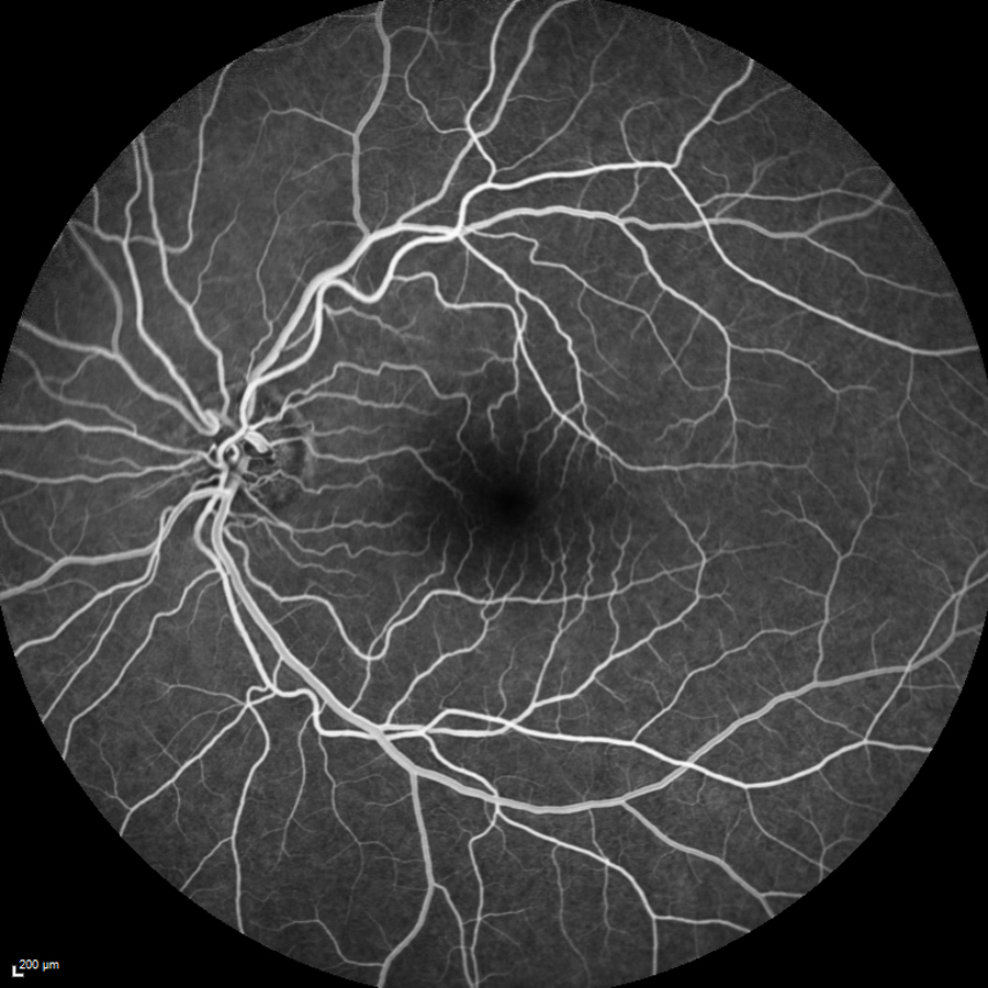 Post-fluocinolone acetonide intravitreal implant FA of the left eye demonstrating resolution of the abnormal multifocal punctate hyperfluorescence