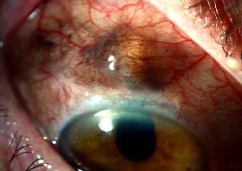 Superior conjunctiva showing iris prolapse with overlying conjunctival pigmentation on repeat evaluation, 2 weeks following initial presentation