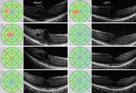 Right and left serial optical coherence tomography data at presentation (A), 2 months (B), 5 months (C), and 6 months (D). Macular thickness profiles (in micrometers) are shown beside the cross-sectional foveal images.