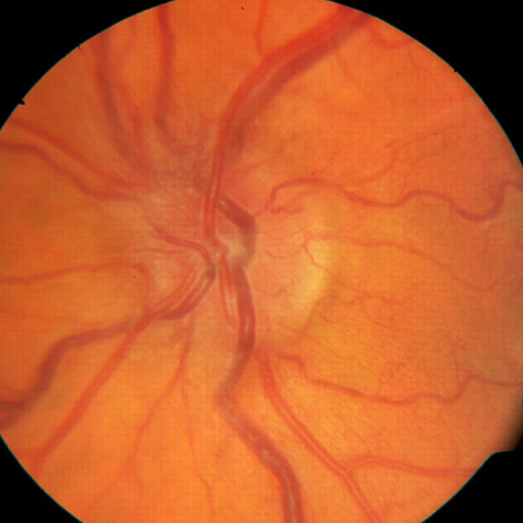 Photographs of the retina 10 months after trauma, showing disc edema, dilated veins, and tortuous vessels in the left eye.