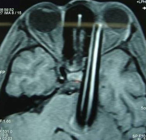 Computed tomography (CT) revealed an intraorbital foreign body. The hospital neurosurgeon was consulted and a magnetic resonance imaging (MRI) scan was requested. The MRI revealed a long, linear orbital foreign body extending from the left orbit through the medial part of the temporal lobe up to the brain stem (Figure 2). When confronted with the MRI report, the patientâ€™s mother continued to deny any injury with a sharp object. Based on the general condition of the patient, absence of neurological deficits and radiological findings, the neurosurgeon did not recommend an angiography.