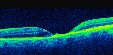 Optical coherence tomography changes in macular CMV retinitis.
