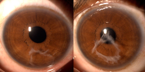 Anterior segment photographs of the right and left eyes showing the empty capsular bag in the anterior chamber.