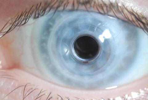 Postoperative photograph of the left eye 5 years after surgery with visual acuity of 20/30 (3 failed PKs had left the patient with a preoperative vision of hand movements).