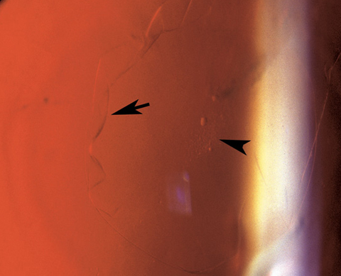 Left eye showing edge of floating anterior capsular fold on retro-illumination (arrow) and anterior subcapsular cataract opacity (arrowhead)
