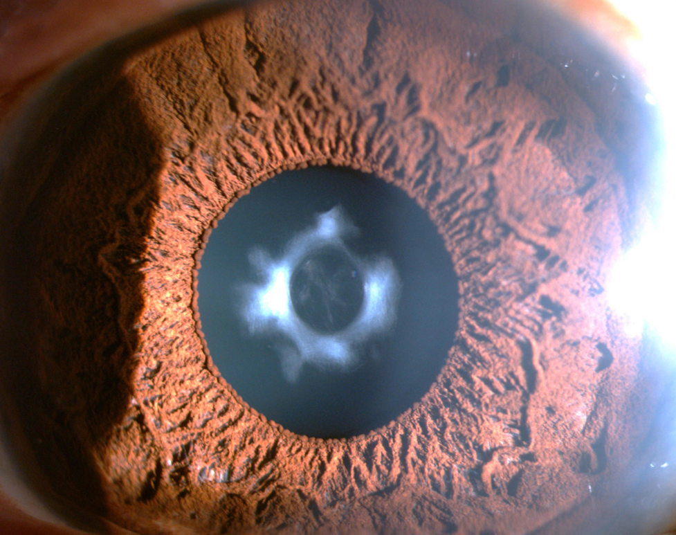 Healed central capsular defect with opacification of capsular edges and underlying lens cortex