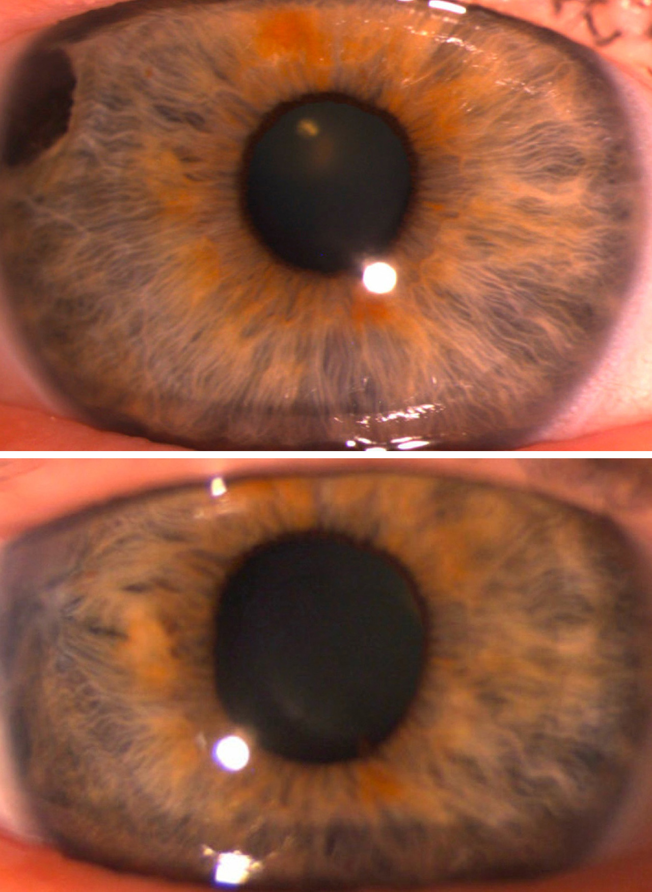Slit lamp photograph of right eye anterior segment on presentation and following  lesion removal and iridoplasty.