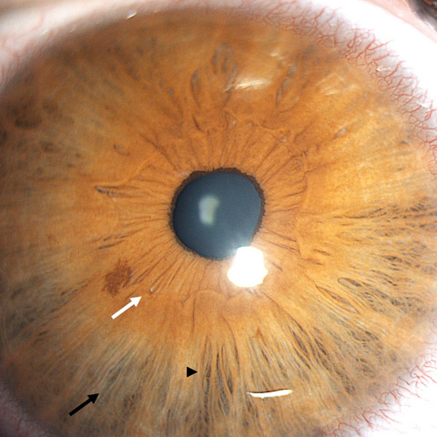 A 15-year-old boy with Williams-Beuren syndrome (WBS; OMIM #194050) with stellate iris pattern.