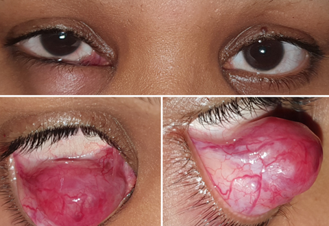 Diffuse right lower lid swelling and nodular appearance on lid eversion.