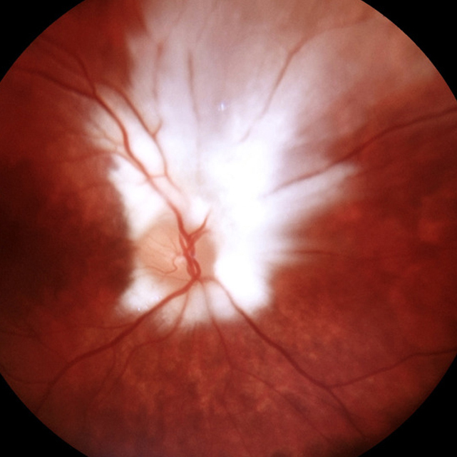 Dilated fundus examination revealed the presence of an extensive myelinated nerve fiber layer in the right eye surrounding the entire optic nerve, with feathery extensions superiorly.