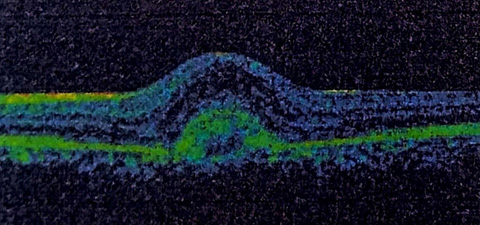 OCT scan of the left eye, with hyperreflective choroidal neovascular membrane in the foveal area and some retinal thickening, 8 months following the ingestion of sildenafil and formation of a focal choroidal excavation.