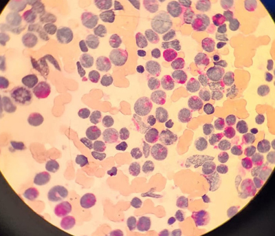 Bone marrow smear showing invasion of large granular blasts.