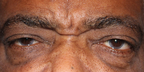 Preoperative photograph of patient showing bilateral ptosis.