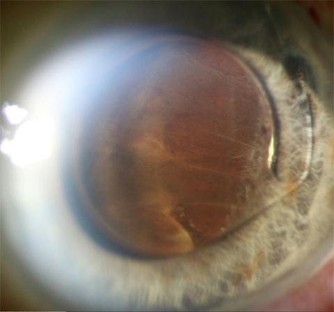 The choroidal hemorrhages were appositional and abutting the ACIOL.