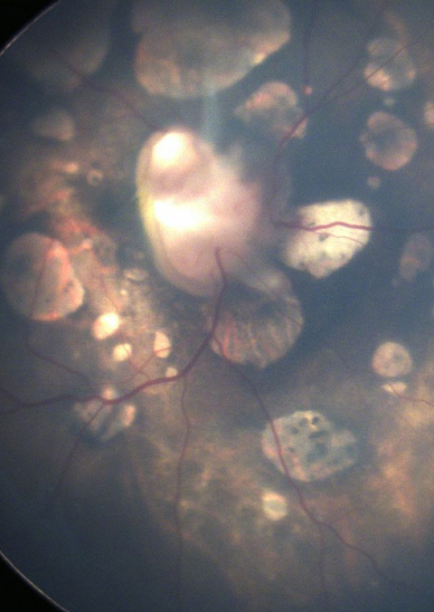 Fundus examination revealed chorioretinal lacunae involving the posterior pole in right eye and retinal detachment in the left eye.