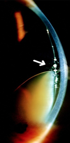 A narrow slit-beam examination angled at 60° showed the “triangle sign” indicative of Morgagnian cataract—a triangular area formed by the anterior and posterior lens capsule at the apex and the lens nucleus at the base.
