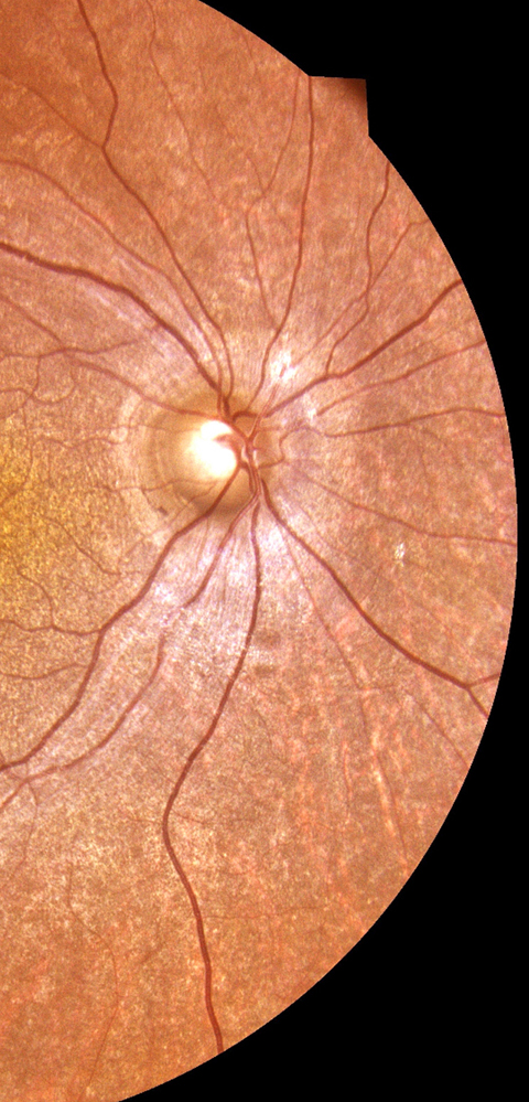 Funduscopic examination revealed atrophic bull’s eye maculopathy, with concentric rings of hypopigmentation and hyperpigmentation surrounding the fovea in the right eye.