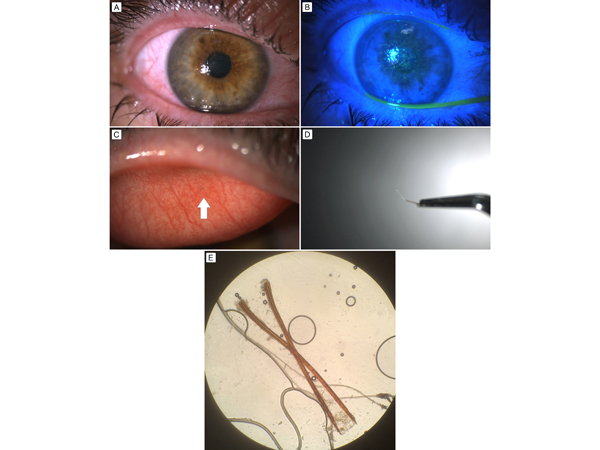"Migration of retained tarsal bee stinger onto the ocular surface causing superficial keratopathy," Figure 1