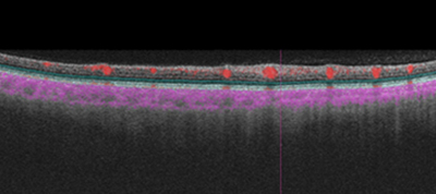 OCT angiography (cross-sectional view of right eye) obtained at initial presentation showing vessel tortuosity with high flow with no flow voids.