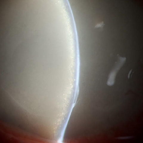 Slit-lamp examination showed injection of the bulbar conjunctiva, corneal limbal neovascularization, two bullae under the corneal epithelium, and an anterior chamber filled with silicone oil emulsion particles, which had a glittering appearance.